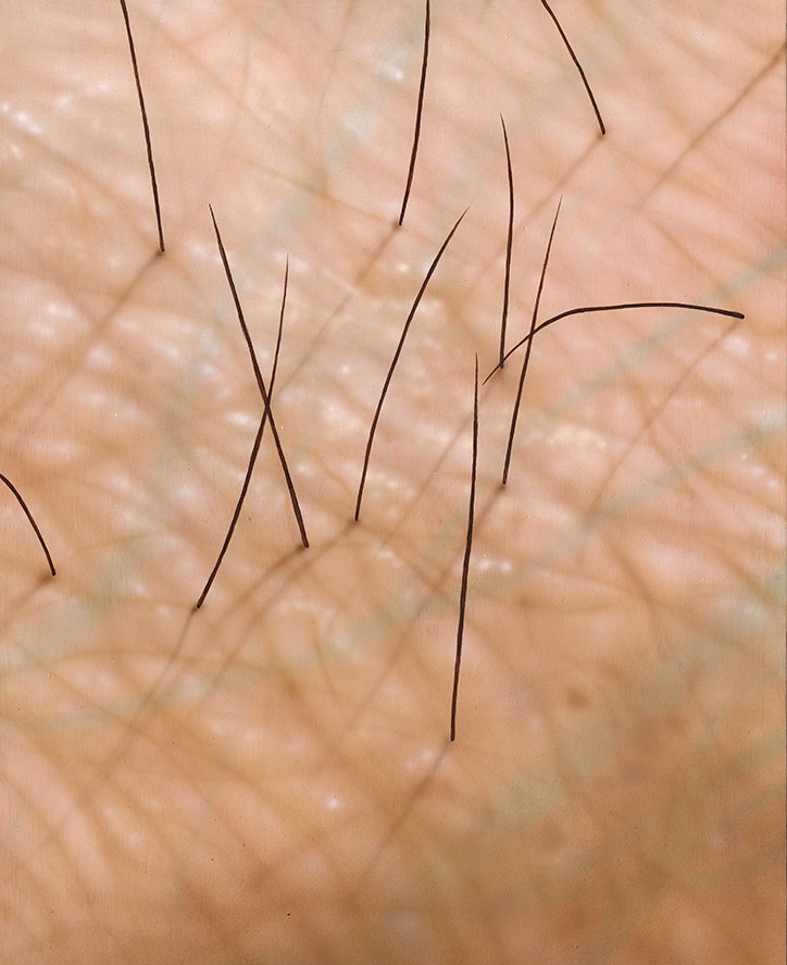 An extreme close-up of skin showing several thin, dark hairs growing from the surface. The skin is pale and textured with a network of fine lines.